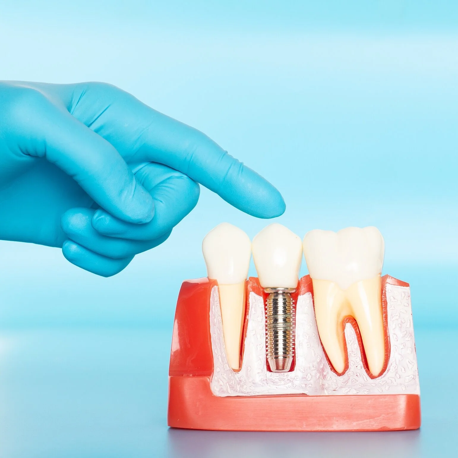 dental implant model